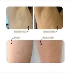 Kenzzi Multi-Lens IPL Hair Removal Device White Gold Legs Arms