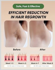 XSOUL At-Home IPL Permanent Hair Removal Tool for Women and Men