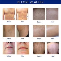 755nm/808nm/1064nm Hair Removal Diode Laser Machine Permanent Painless Beauty