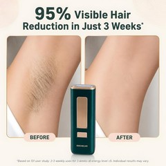 Ultimate IPL Hair Removal Bundle – Razor, Eyewear & Five Heat Settings Included