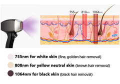 808 Diode Laser Hair Removal Yag 755 808 1064 Diode Laser Hair Removal Machine