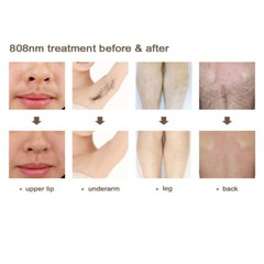 110V Laser Hair Removal Permanent By Laser 808nm Laser Hair Removal Machine