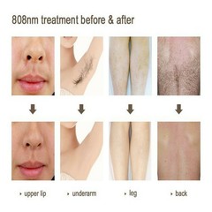 2In1 Diode Laser Hair Removal ND YAG Picosecond Tattoo Removal Skin Care Machine