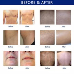 Painless Hair Removal 810nm Machine Diode Laser Ice Skin Rejuvenation Whitening