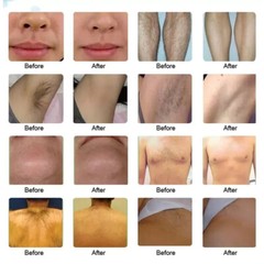 Ice Titanium 755 808 1064nm Permanent Painless Diode Laser hair removal Machine