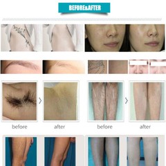 2 IN 1 Diode Laser Soprano Hair Removal Picosecond Laser Tattoo Removal Machine