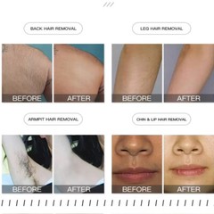 2IN1 Hair Removal Diode Laser&Picosecond Nd Yag Tattoo Removal Machine Skin Care
