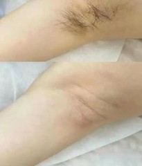 2026 Alma Soprano ICE Titanium Diode Laser Hair Removal Machine 755/808/1064nm