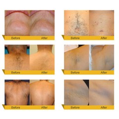 Diode Laser Hair Removal Machine 755 808 1064nm Cooling Head Painless Epilator