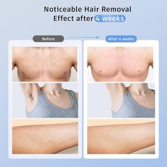 Laser Hair Removal with 5℃ Ice Cooling, Painless IPL Laser Hair Removal 3 in 1