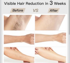 BoSidin Pioneer-Pro Permanent Hair Removal Device