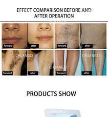 808 Diode Laser Hair Removal Yag 755 808 1064 Diode Laser Hair Removal Machine