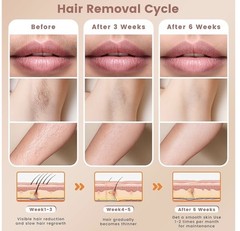 LASER Hair Removal Device, Hair Removal at home for Body, Armpits & Legs