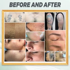 755 808 1064nm Diode Laser Bikini Body Hair Removal Permanent Skin Care Machine
