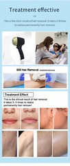 3000W Diode Laser 755 808 1064nm Hair Removal Laser Machine 12 bar Beauty SPA