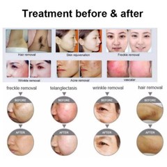 3 Filters Hair Remove Machine IPL Radio Body Frequency Epilator Wrinkle Removal