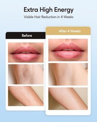 IPL Hair Removal Device Painless Long-Lasting Results for Women Bikini Legs Arms
