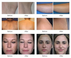 IPL OPT SHR Laser Hair Removal Skin Rejuvenation Acne Vascular Removal Machine