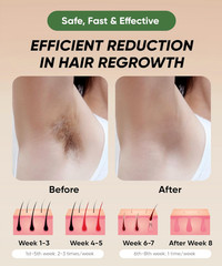 Handheld Light-Based Hair Removal Device – At-Home Cosmetic Tool, Free USA Shipp