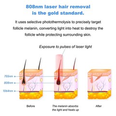 Hot Portable Permanent Diode Laser Hair Removal Machine 808nm Skin Rejuvenation