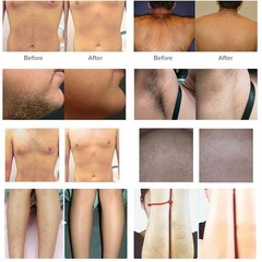 Professtional OPT SHR IPL Hair Removal ND YAG Laser Tattoo Remove Spa Machine