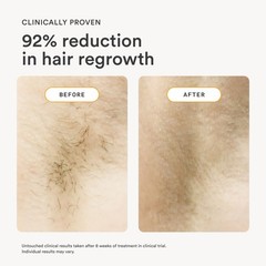 Nood The Flasher IPL Permanent Hair Removal Pain-Free LED Display 2.0