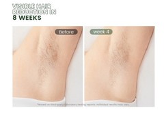 XSOUL At-Home IPL Permanent Hair Removal Tool for Women and Men