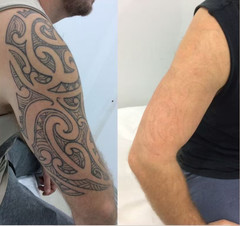 Laser Hair Removal, Picosecond Safe And Painless Hair Removal, Tattoo Removal