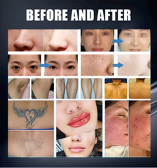 IPL OPT RF Nd Yag Picosecond Laser Hair Removal Tattoo Pigment Removal Machine