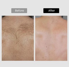 DermRays V8S *Enhanced Edition* Diode Laser Hair Removal, Pro-level cooling