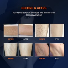 755/1064nm Alexandrite Long-Pulse Fiber Semiconductor Laser Hair Removal Machine