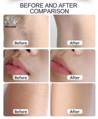 Upgraded FAC Diode Pico Laser Hair Reduction Tattoo Removal Salon Machine