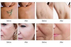 3000W 808 Diode Laser Hair Removal Pico Laser pigmentation removal Machine 2in1