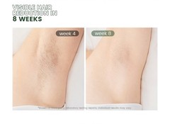 XSOUL At-Home IPL Permanent Hair Removal Tool for Women and Men