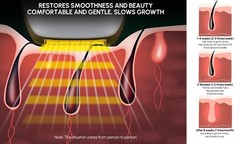 IPL Laser/Light Hair Removal see result in weeks