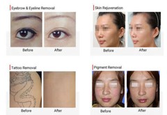 Diode Laser Hair Removal Machine ND YAG LASER Tattoo Removal Skin Rejuevantion