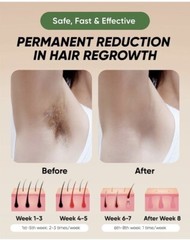 XSOUL At-Home IPL Hair Removal