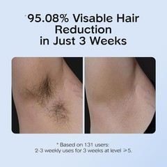 Advanced IPL Hair Removal with Ice Cooling – 9 Energy Levels for Perfect Comfort
