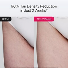 Complete Home Hair Removal Kit: Air 10 IPL Device with Luxe Case & Accessories