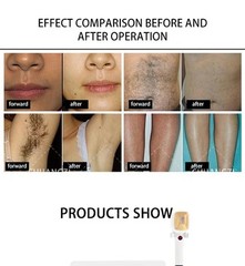 Professional 2026 ICE Titanium 755/808/1064 Diode Laser Hair Removal System