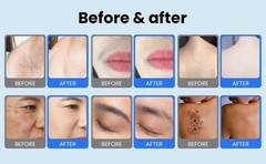 2 in 1 LCD Touch Handle Diode Laser Hair Removal & Pico Tattoo Removal Machine