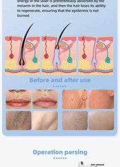 2000W Ice Titanium 755nm 808nm 1064nm Diode Laser Painless Hair Removal Machine