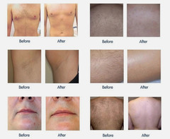 High-quality 755/808/1064nm laser hair removal device, painless hair removal.