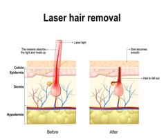 808nm Diode Laser Hair Removal 808 1064 755nm Painless Permanent Epilator