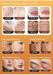 Four-in-one beauty device: hair removal, skin rejuvenation, spot fading, and tig