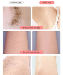 2IN1 755nm 808nm 1064nm Diode Laser Hair Removal Pico Tattoo IPL NG YAG Machine